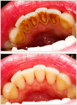Zahnstein Vorher Nachher